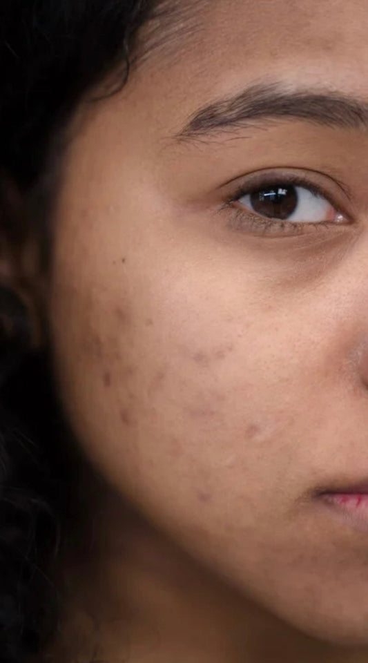 The Real Truth About Dark Spots on Melanin-Rich Skin (And How to Get Rid of Them)